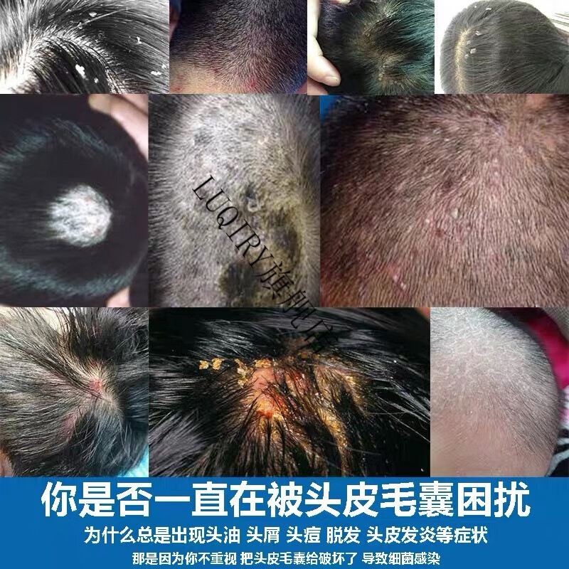 头上长疙瘩头上长红疙瘩头上长红疙瘩头皮长痘痘痒头皮屑多洗发水毛囊