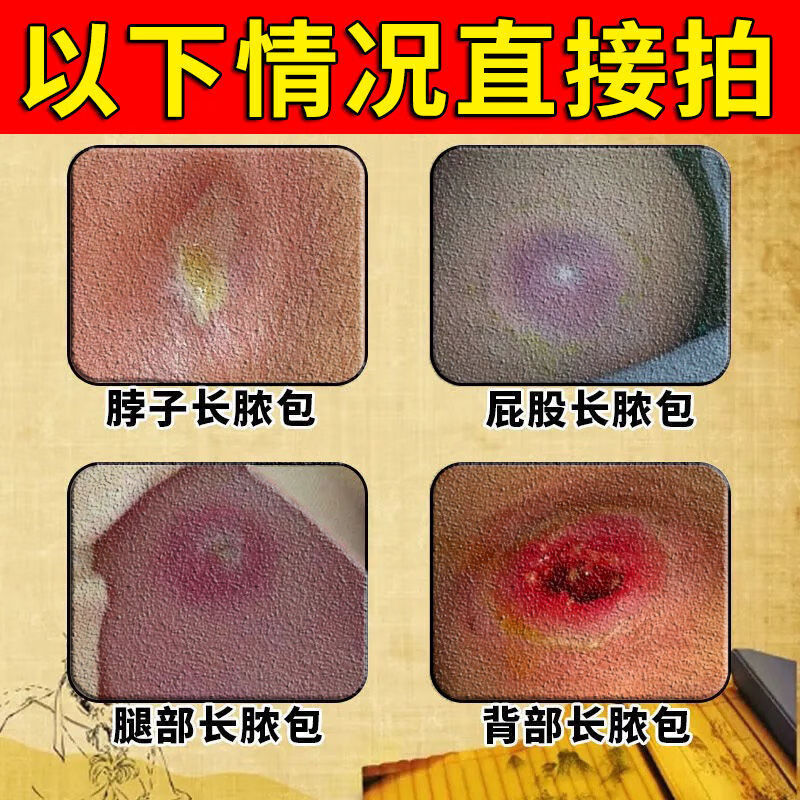 火疖子消毒膏疖子拔脓贴疖疮贴毛囊炎脓包硬块疙瘩大脓包痘痘坐扳疮