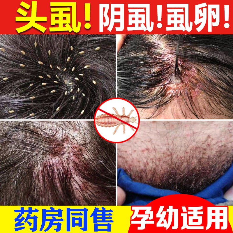 药房直售芙养灵虱子药儿童头虱虫卵孕妇用去阴虱百部酊 喷剂 一瓶