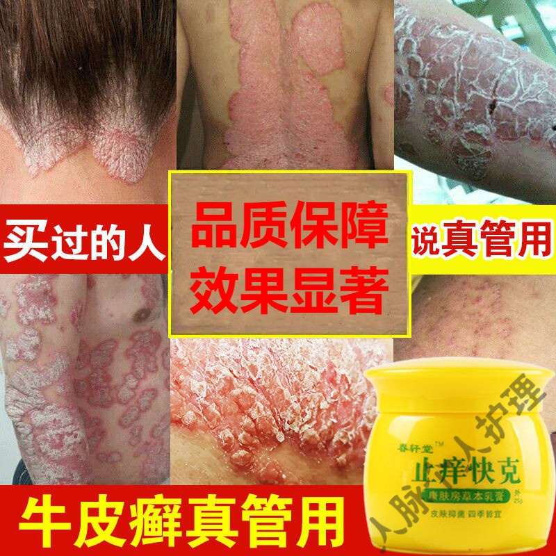 癣手足l癣皮l焱止痒膏虎毒膏止痒快克皮肤瘙痒专用各种l藓l症私处瘙痒