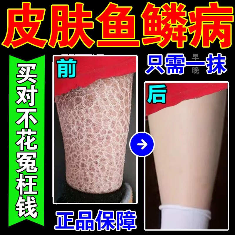 鳞病专用皮肤霜去鳞药修复皮肤干燥脱皮开裂鸡皮肤嫩肤净肤膏 单盒