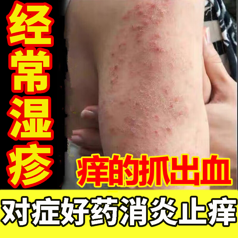 慢性湿疹皮炎湿疹药 皮肤瘙痒大腿内侧瘙痒红疹皮肤红肿瘙痒红斑 皮肤