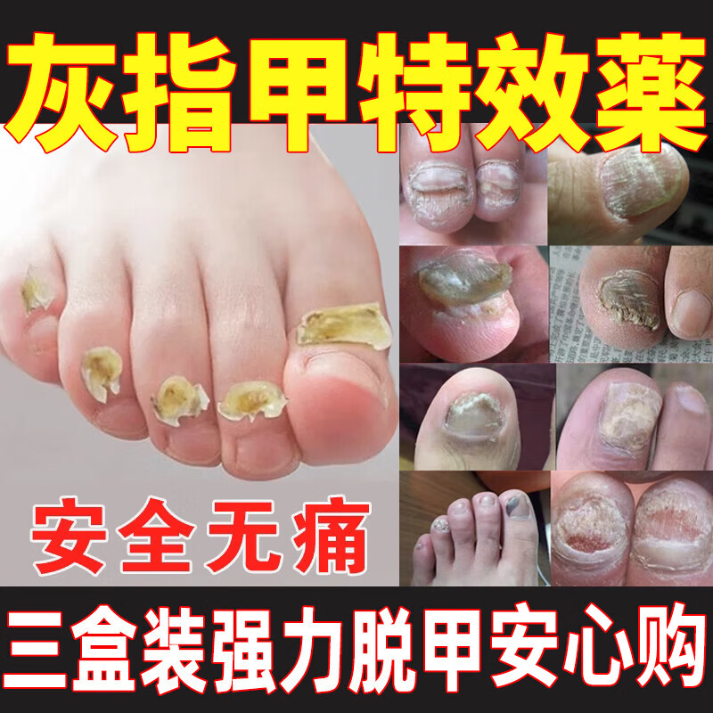 增厚变空黑灰甲净根膏治真菌感染甲沟炎脚趾脱甲凤仙花抑菌溶液三盒装