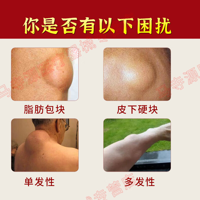 马寺源脂肪瘤贴皮下脂肪包块纤维瘤粉瘤肿块囊肿硬块消瘤膏贴舒缓贴 买五发八