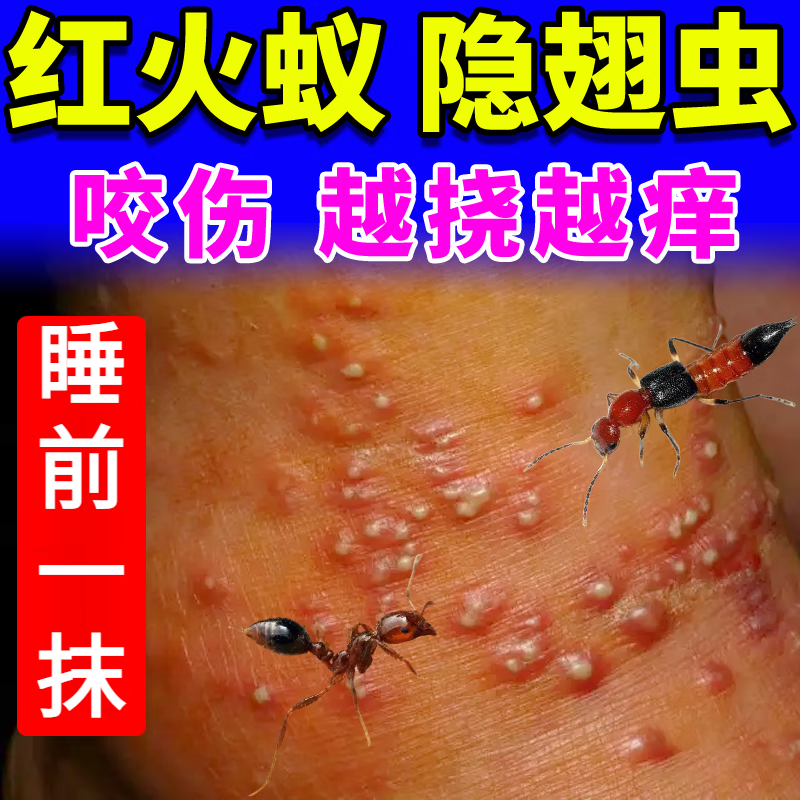 蜈蚣叮咬瘙痒烧灼疼痛祛痒消肿臭虫毒虫隐翅虫蚊虫叮咬止消肿痒过敏 1