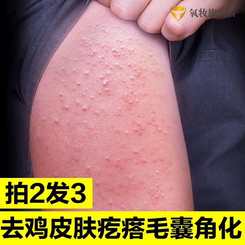 沙棘可以去鸡皮肤吗(沙棘可以去鸡皮肤吗图片)