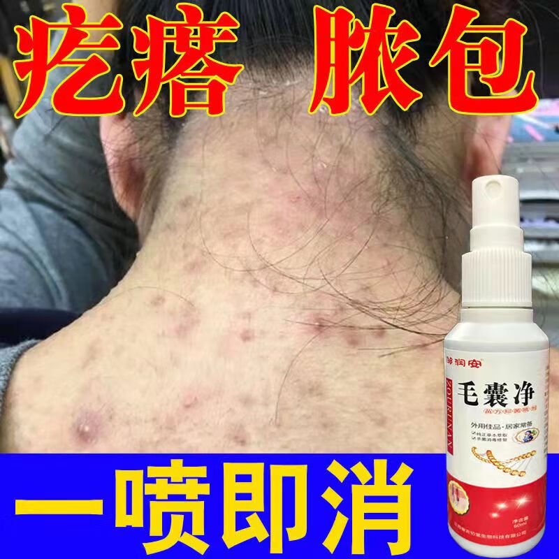 痤l疮痘痘止痒皮肤瘙痒痱子疙瘩头上脓包疙瘩真菌感染毛囊堵塞专用 1