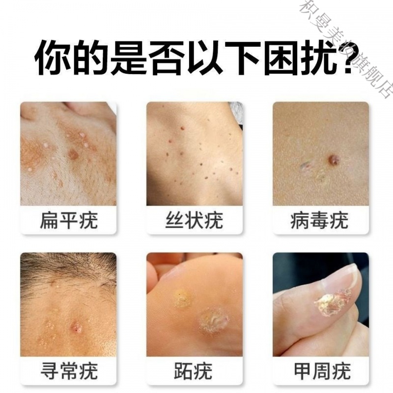 草本克l疣液面部l疣扁平尤脖子腋下肉粒尖锐丝状l疣手部足部寻常l疣