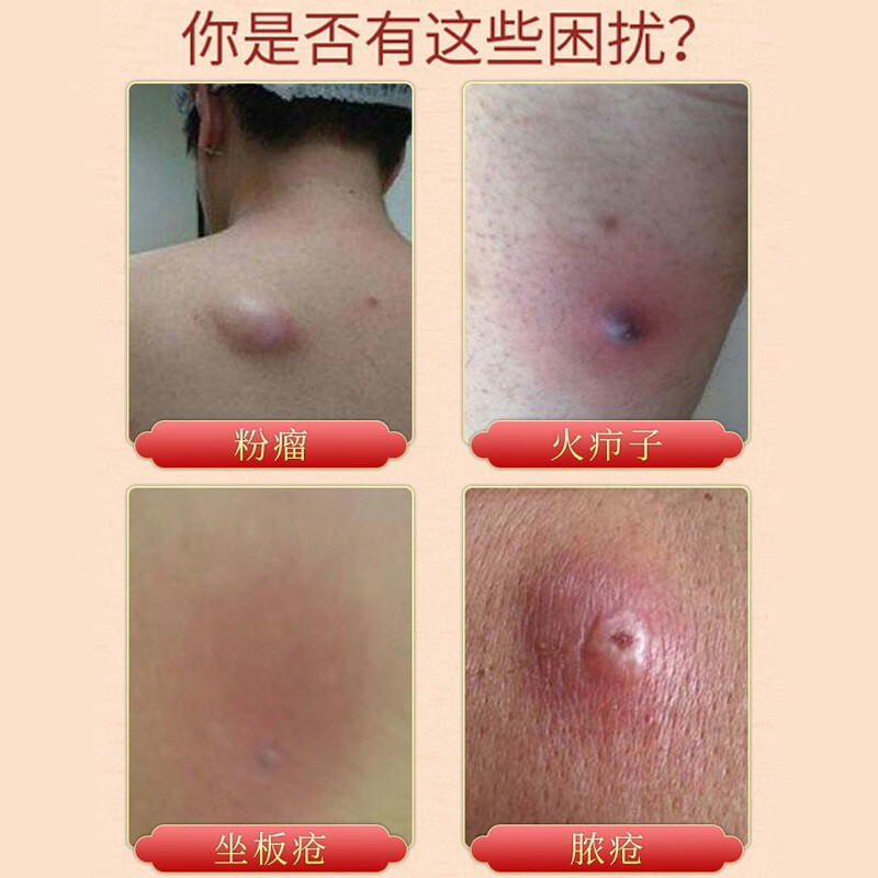 皮脂腺囊肿速消药去除粉瘤痘痘皮下红肿硬块脓包火疖子拔i毒膏 1盒