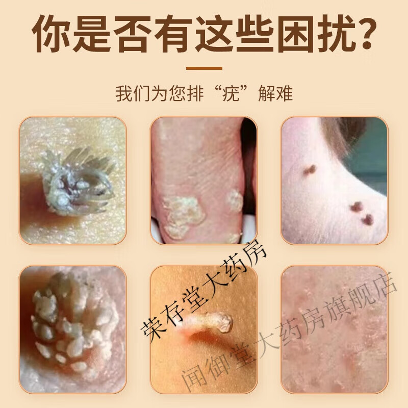 【药房直售】广州白云山优肤平 跖瘊疣灵老茧丝状疣液点痣膏 克疣液贴