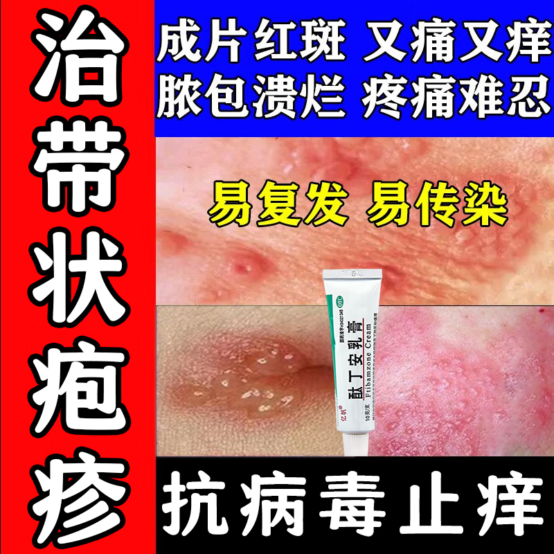 带状疱疹特痒效药后遗症神经痛用药治蛇盘疮缠腰引起水泡脓包瘙痒溃烂