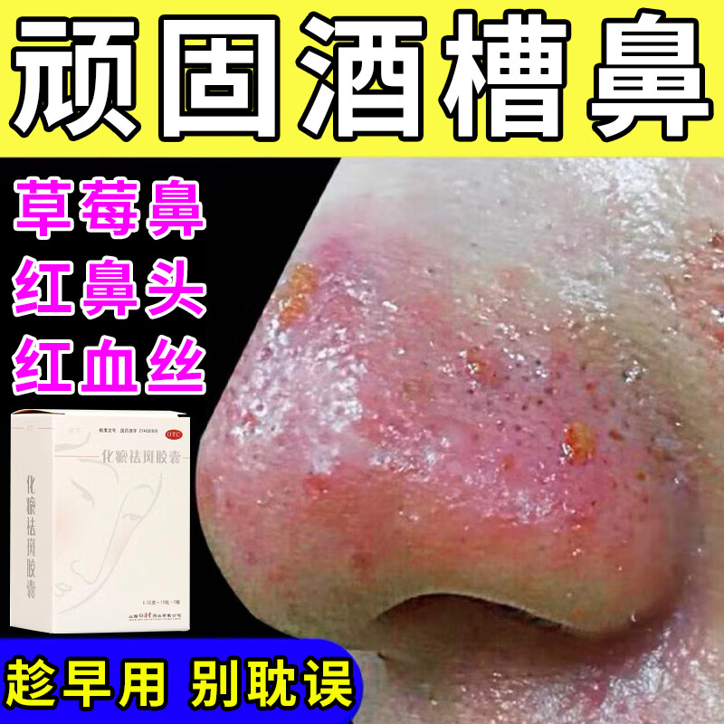 酒糟鼻专用药】草莓鼻红鼻子红血丝修复药酒渣鼻鼻子红肿长痘脓包去
