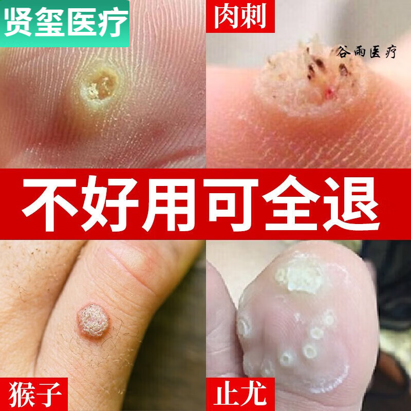 京健康鸦胆子疣猴子膏手上脚上长硬疙瘩肉刺刺瘊子净祛不去除 去 去非