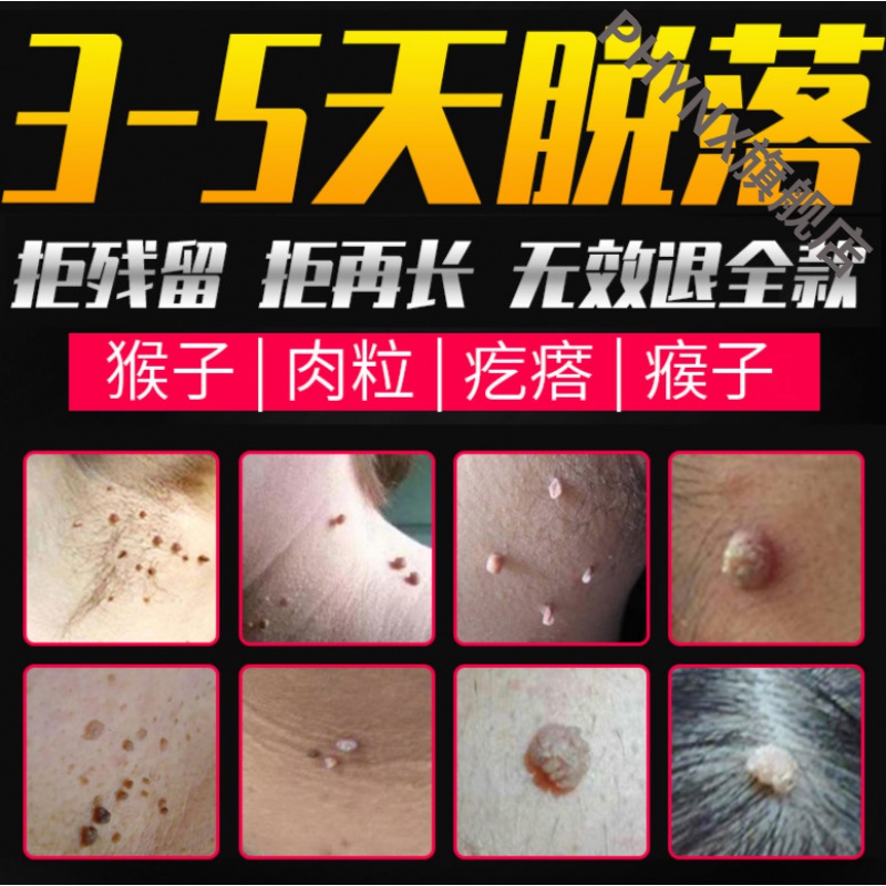 去猴子肉粒疙瘩专用箹瘊l子去除膏訷器的脖子上长小肉粒治刺猴 10ml