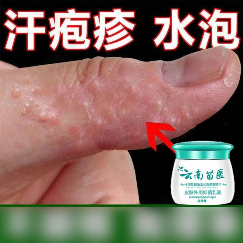 【健康大药房】手足o癣鹅掌风汗疱o疹湿o疹止o痒干裂脱皮真菌感染 菌