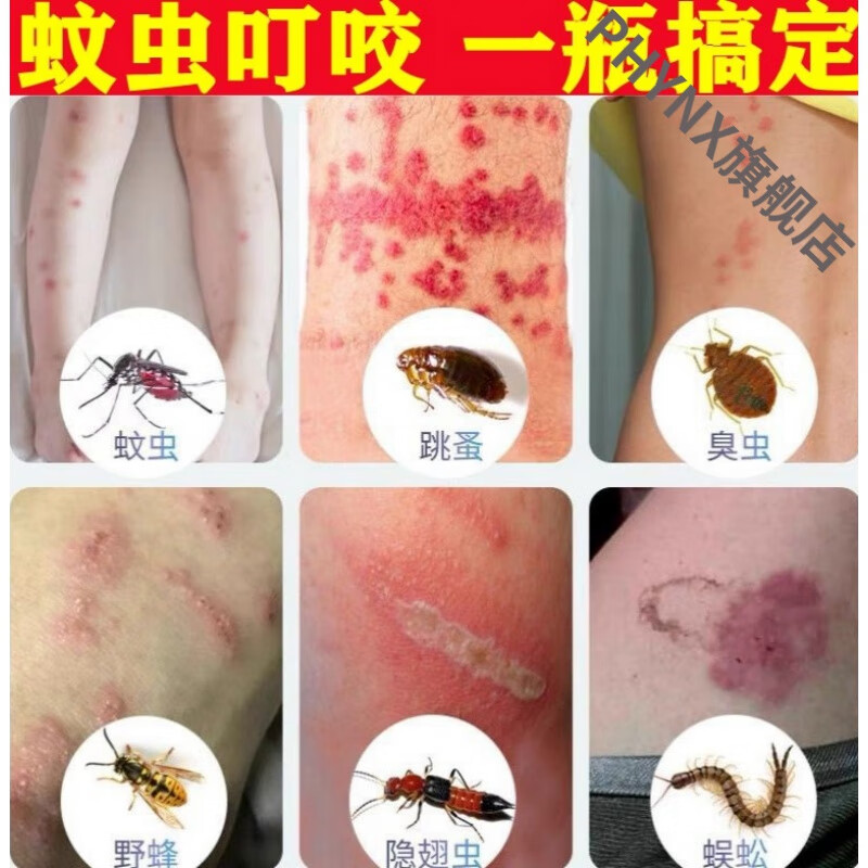 治l疗被蚂蚁咬了伤到膏箹隐翅虫跳蚤虫子叮咬止痒湿l疹牛皮l癣皮肤l病