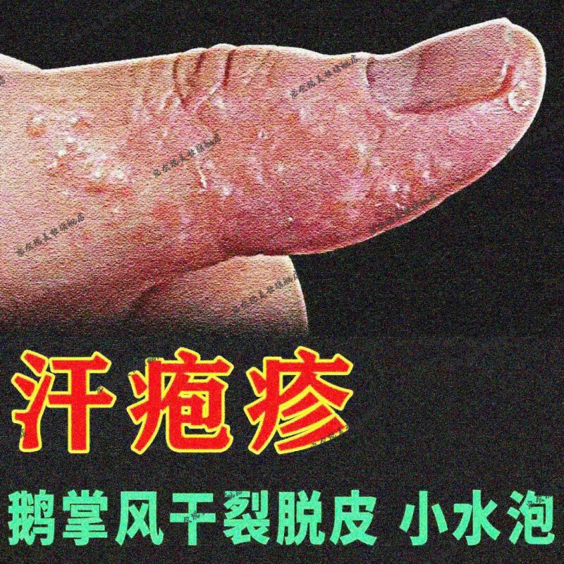 汗l疱l疹手上起小水泡鹅掌风干裂脱皮手痒真菌感染止痒湿l疹止痒膏 1