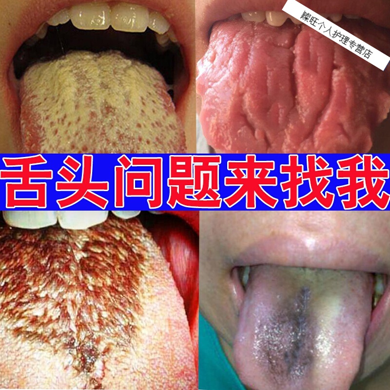 舌头开裂沟纹舌裂纹地图舌乳头发i炎齿痕舌起泡疼痛喷剂止i痛訷器