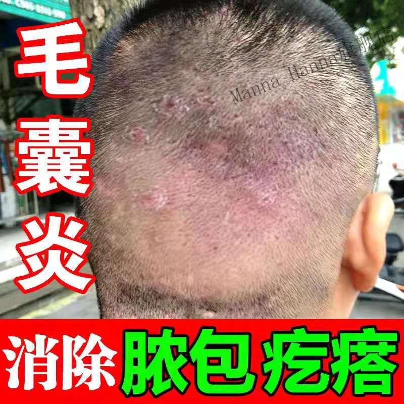 治l疗毛囊l炎头皮l藓膏头皮脸头部头上长痘痘背上前胸后背私处专用箹