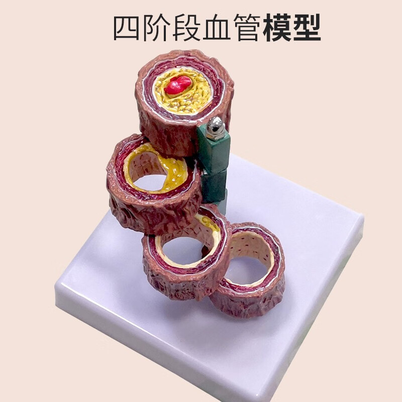 血管/堵塞动支脉粥样/硬化心血管动脉/ 硬化模型血管病理模型血管病理