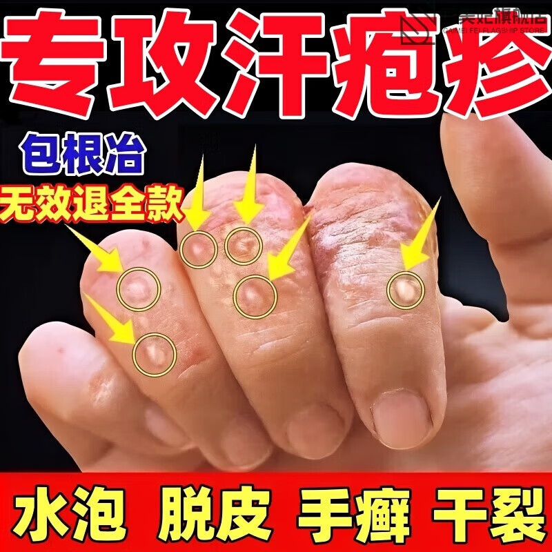 彩美妃仁瑞堂尼坤膏手i癣手足i癣真菌感染水泡脱皮干裂皮i炎湿i疹止 1