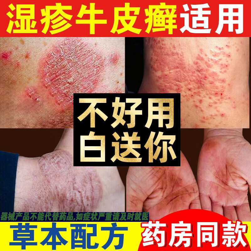 苗居堂万藓灵湿疹膏皮炎皮肤瘙痒股藓止痒去大腿根内侧牛皮癣专用软膏