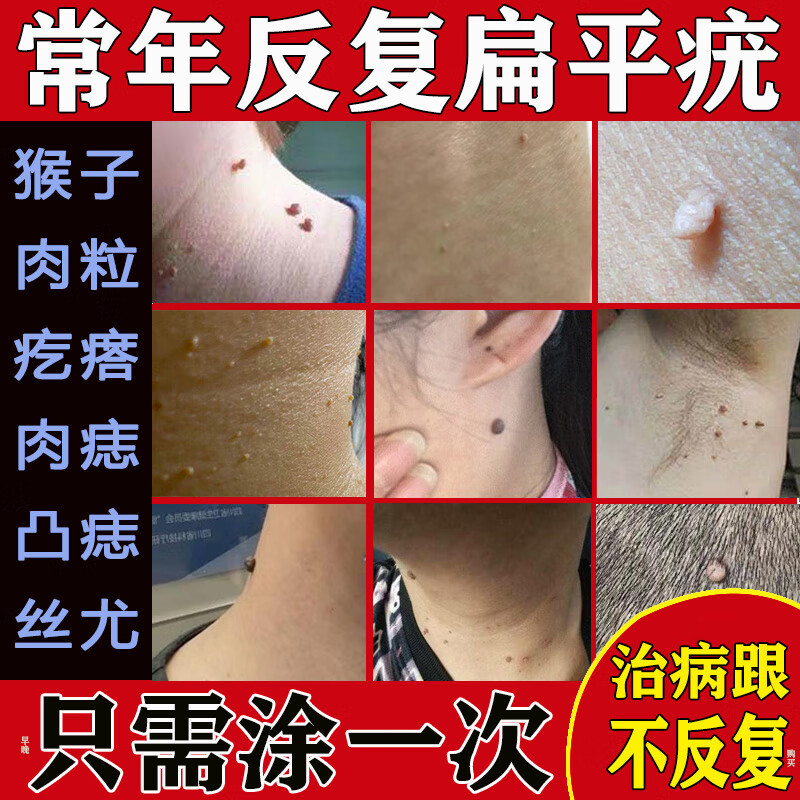 去猴子面部瘊子除小肉粒疙瘩猴子去除丝状疣跖疣祛疣膏一抹灵皮肤用药