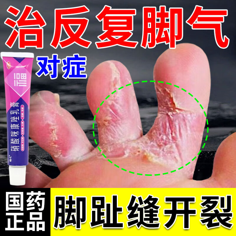 脚趾缝溃烂开裂痒】脚气药止痒脱皮烂脚丫真菌感染止痒根糜烂型脚气治