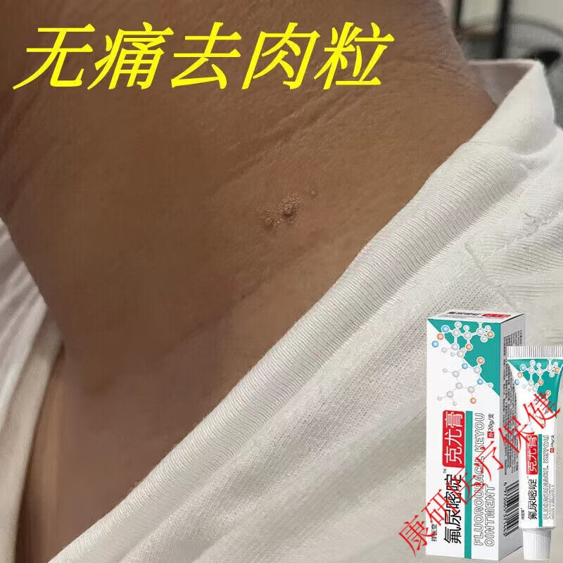鸡尤康氟尿嘧啶软膏乳膏克疣膏跖疣脚底疣脚垫老茧瘊刺肉子猴 1盒装
