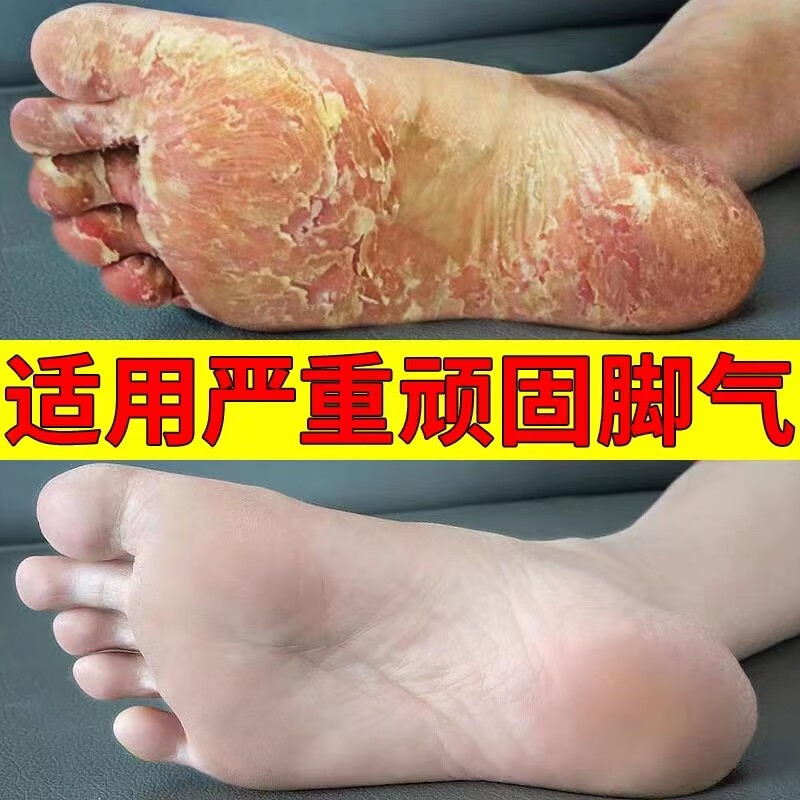 诗莱格脚气止痒脱皮杀菌脚丫脚真菌感染脚痒去水泡脚丫消臭去痒脚气