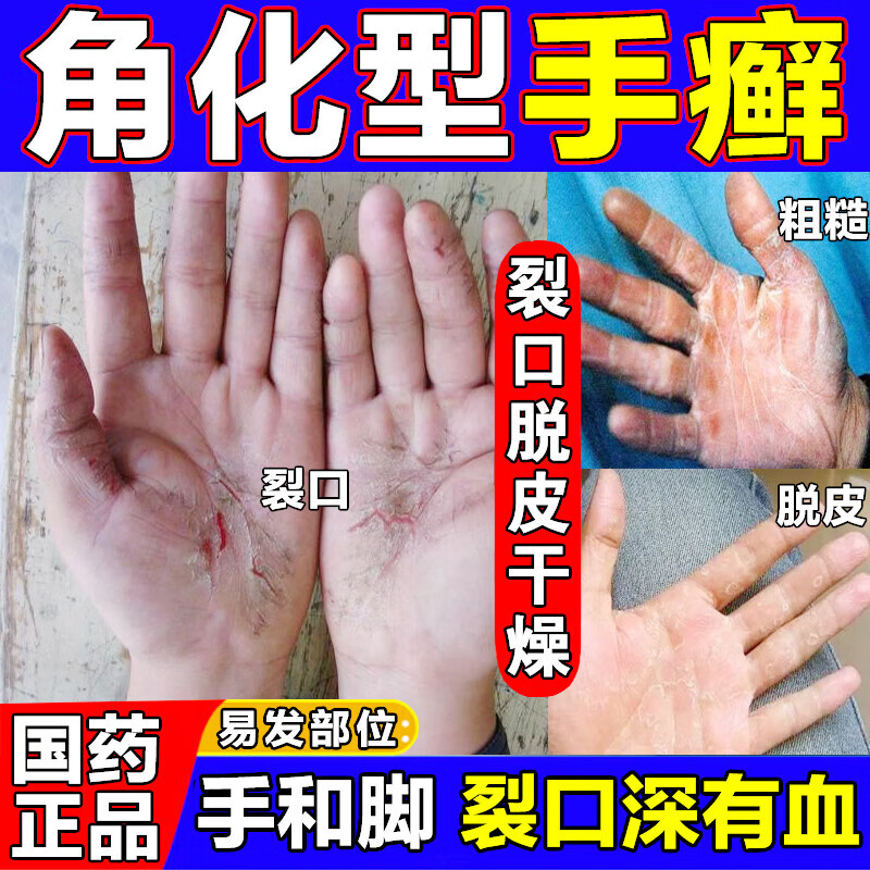 手指关节癣手掌粗糙增厚真菌感染药膏脱皮开裂干裂皮肤瘙痒皮炎克霉唑