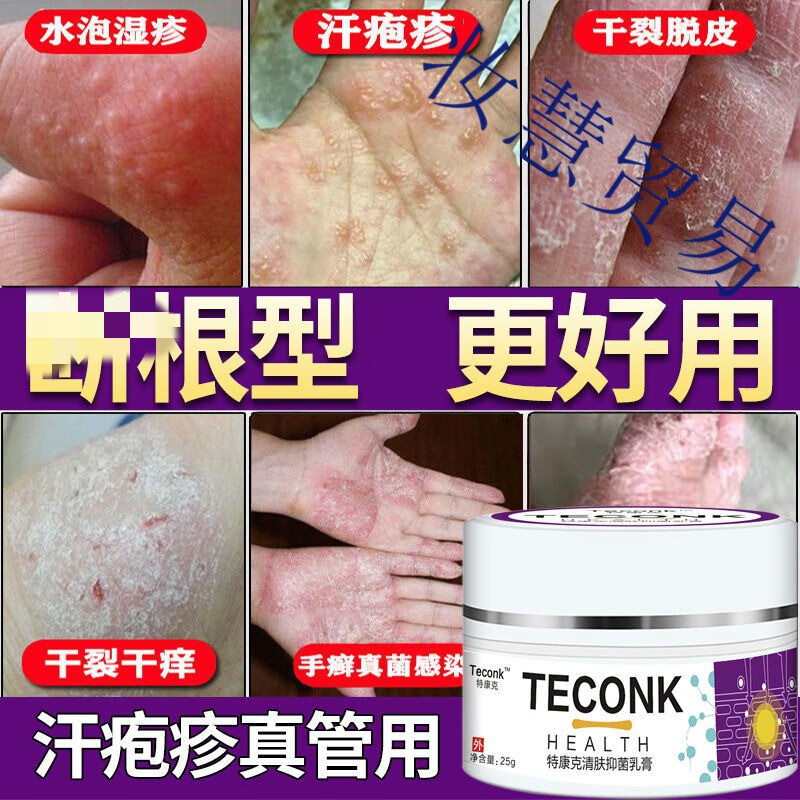 治汗l疱l疹膏箹特效进口手足l癣膏去手上起水泡痒根脱皮干裂真菌感染
