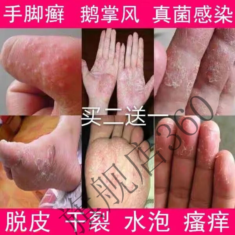 手l癣膏手足l癣真菌感染水泡手痒脱皮干裂皮o炎湿l疹止痒膏鹅掌风箹o