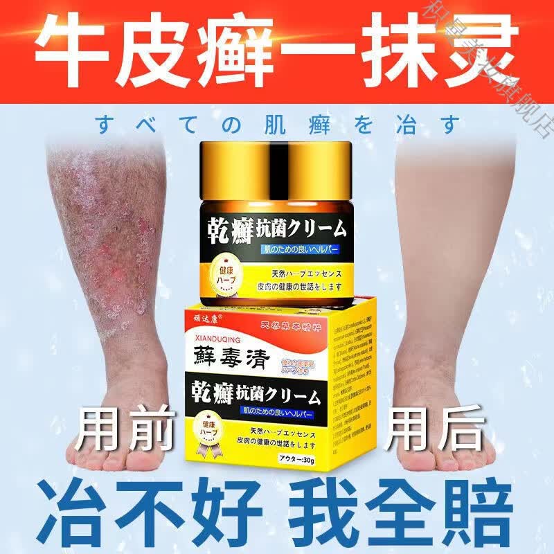 【3天 冶俞】日本进口止痒乳膏专攻手l癣腿l癣红l斑瘙痒鳞屑干燥掉皮