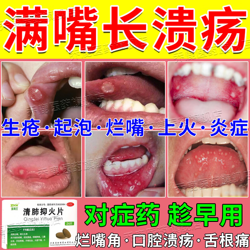 治疗口腔溃疡的药 烂嘴角药口鼻生疮舌头起泡口角炎嘴巴上火起泡下颚