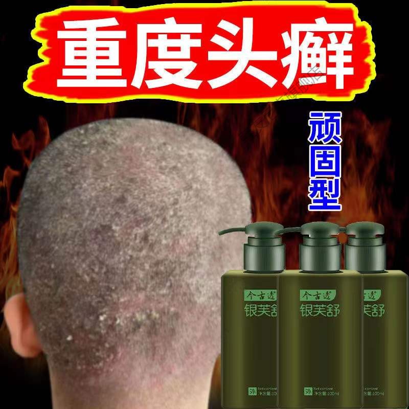 严重牛皮1藓牛皮1癣银1屑头1癣手足1癣体1癣红1斑鳞屑牛皮1癣沐浴露