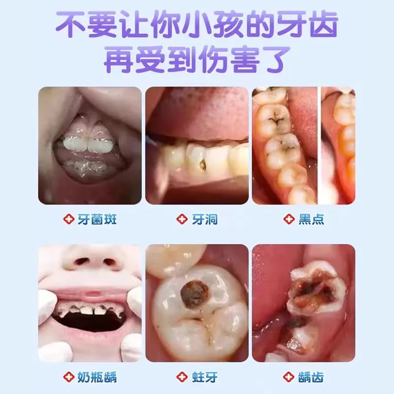 医用级儿童抑菌膏蛀牙洞龋齿牙菌斑口腔 抑菌牙膏 【一盒体验装】
