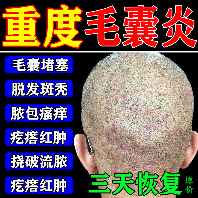 头皮毛囊炎头部专用药膏头上长疙瘩脓包发痒红肿流脓结痂脂溢性皮炎