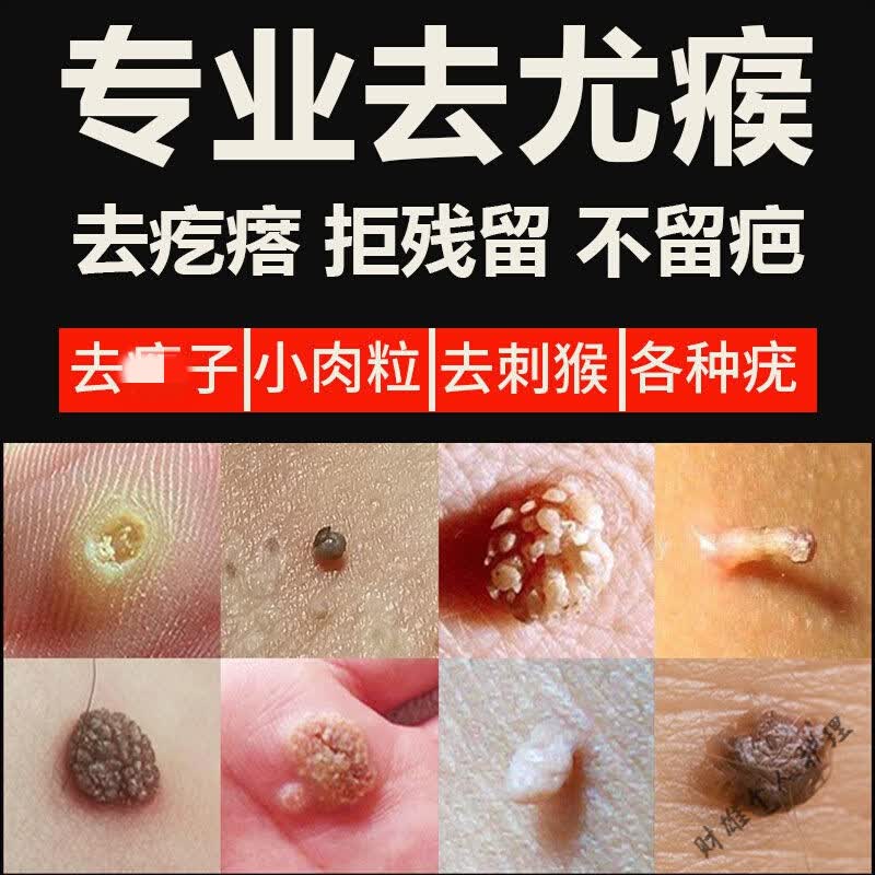 【无痛去尤】去猴子肉疙瘩小肉粒去除刺猴子h瘊膏贴液血泡刺肉血胞刺