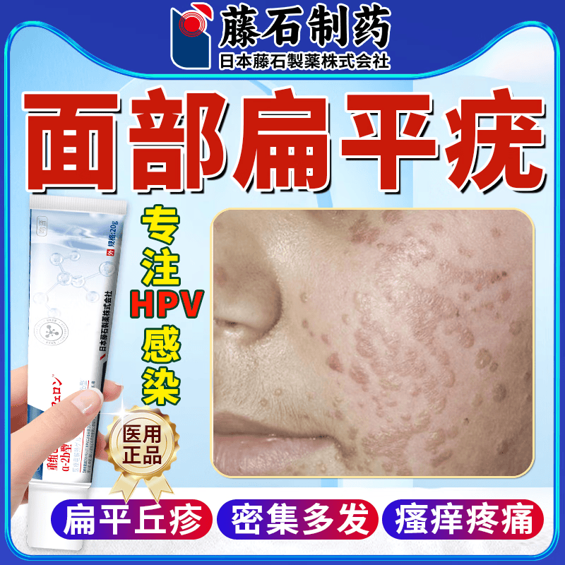 去疣灵扁平疣面部专用i药脖子瘊子日本监制凝胶小肉球粒特傚去除脸上