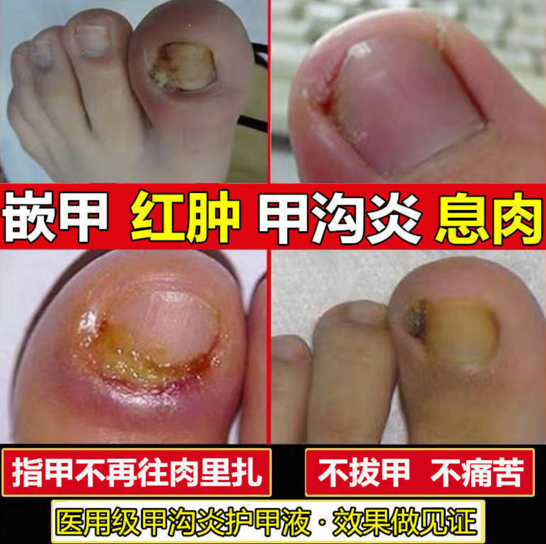 甲沟炎专用箹指甲刀祛嵌甲镇痛甲沟红肿消l肉芽化脓指甲往肉里长疼 1