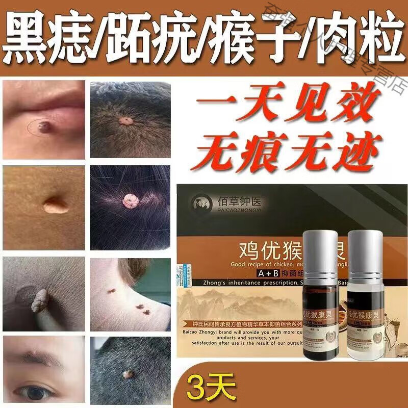 瘊l子扁平l疣平尖锐湿疣脖子腋下丝状忧疣除肉疙瘩皮l赘跖l忧瘊肉子刺