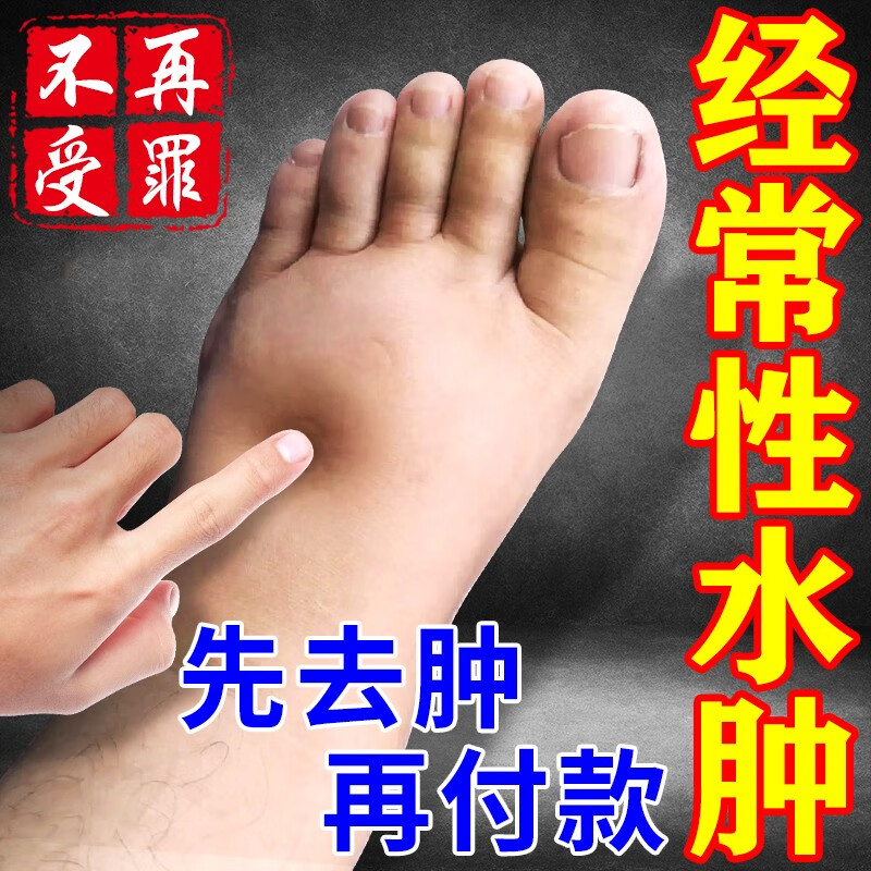 消除水肿消除老脚肿腿肿的药去下肢水肿全身肿胀浮肿贴 单盒[一贴消肿