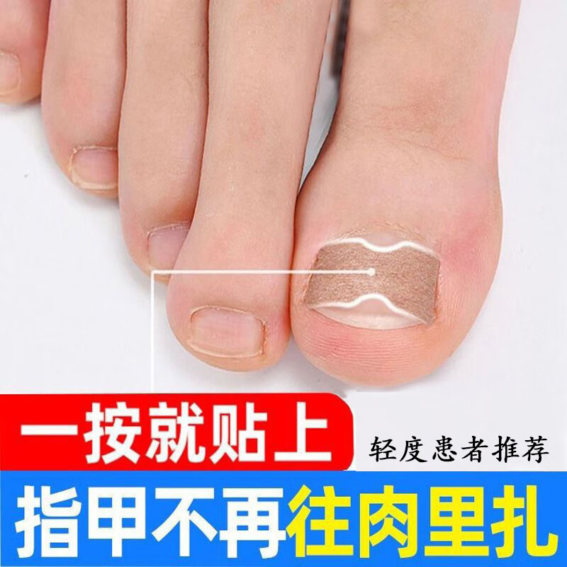 脚趾甲沟炎矫正器正甲贴贴片嵌甲神器指甲长到肉里面正甲扣 轻度患者