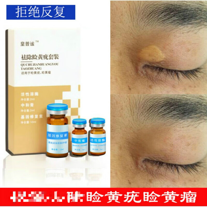 去q除睑黄疣睑黄瘤斑膏圆眼睑黄斑瘤健康膏长黄色瘤眼部黄睑疣瘤科
