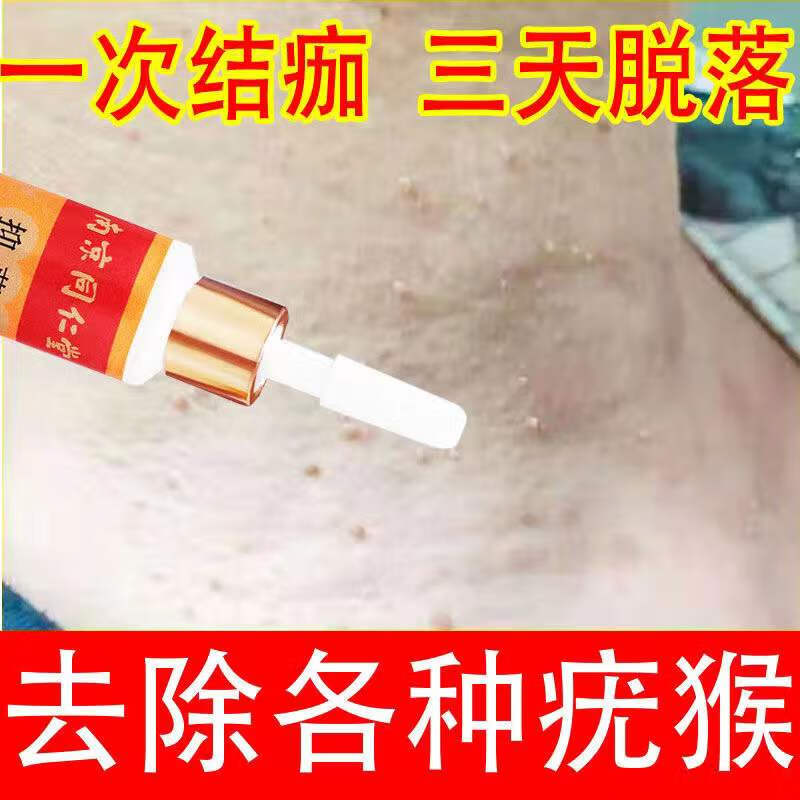 鱼鳞老鼠痣肉粒疙瘩跖寻常老茧子脚茧尤猴净脚底死皮脚垫 一支【快】