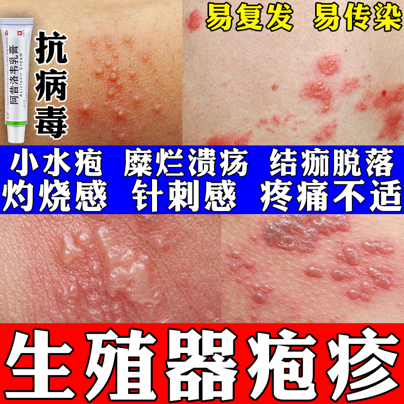 带状疱疹外用药膏 疱疹特疼药生殖防复发皮肤用药阿昔洛韦乳膏 3盒