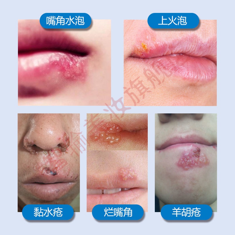 口角炎上火嘴唇起泡烂嘴巴牙龈脓肿包化脓疮水泡嘴唇周红肿痒烂嘴角羊