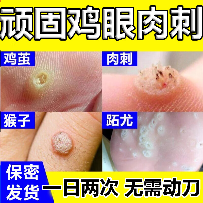 鸡眼贴鸡眼膏去i根去肉刺药i膏刺猴无i痛脱落专的用药特得效药成人