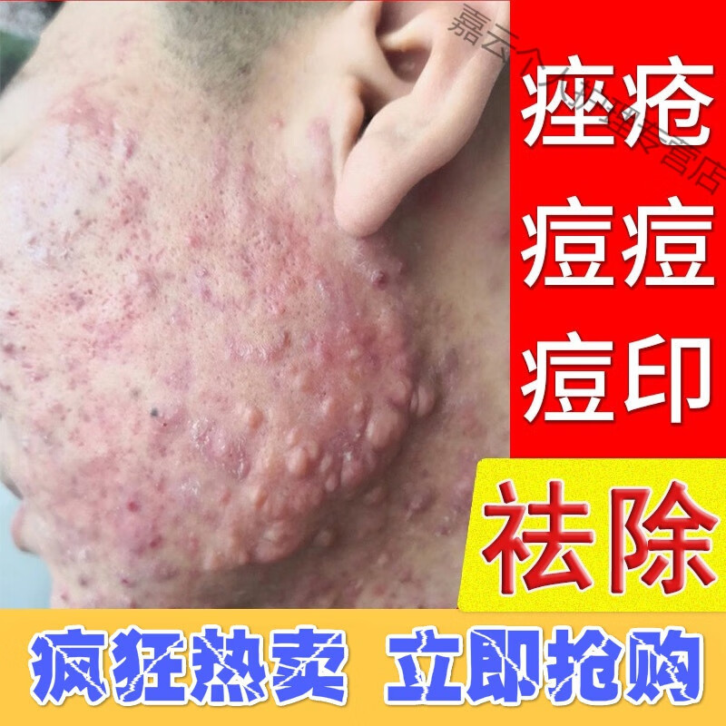 痤i疮膏祛痘重度脸上长痘痘怎么办红肿痘坑 修复痘印訷器座暗疮男女